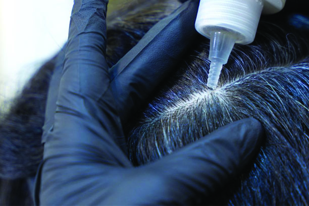 لاین کنترل چربی کف سر